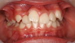 床矯正 八重歯 治療前 三重県